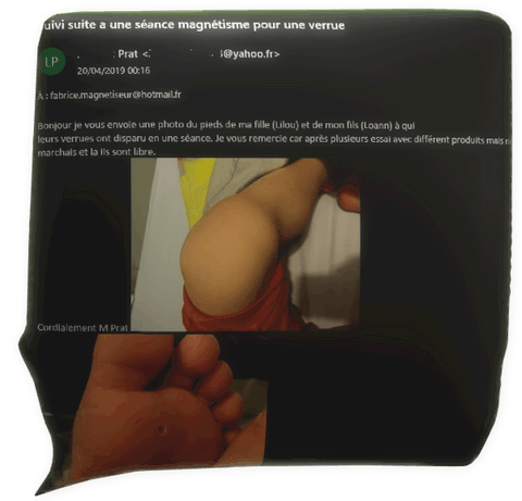 témoignage magnétiseur Lilou Loann Prat verrue plantaire